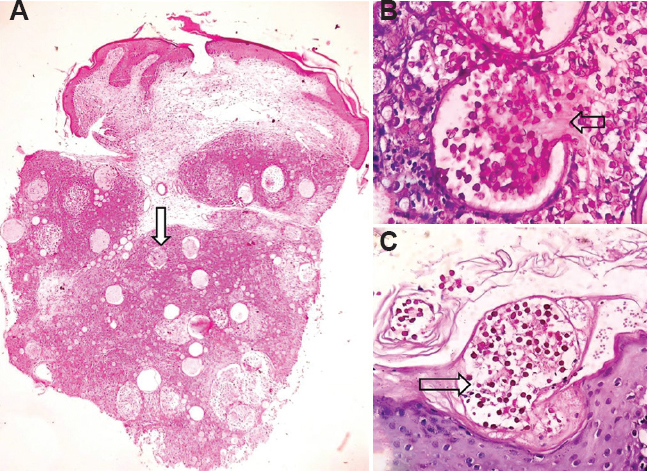 (A) Punch biopsy of the facial lesion showing thinned out epidermis, growing sporangia in the deep dermis and within subcutaneous tissue, surrounded by dense lympho-histiocytic infiltrate (PAS stain, ×4). (B) A mature sporangia with a pore, through which endospores were seen to extrude in the mucoid matrix. (C) Transepidermal elimination of sporangia (PAS stain, ×40).